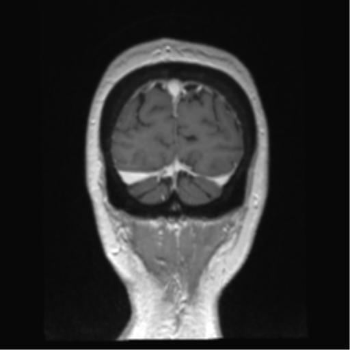 Anterior temporal pole cysts (Radiopaedia 46629-51102 Coronal T1 C+ 20).png