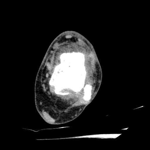 Anterior tibial artery false aneurysm (Radiopaedia 88984-105809 A 142).jpg