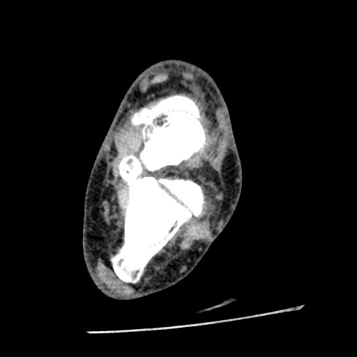 Anterior tibial artery false aneurysm (Radiopaedia 88984-105809 A 156).jpg