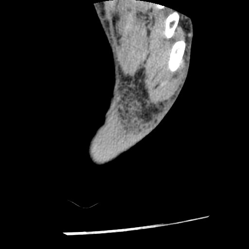 Anterior tibial artery false aneurysm (Radiopaedia 88984-105809 A 256).jpg