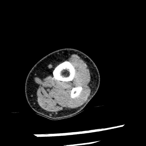 Anterior tibial artery false aneurysm (Radiopaedia 88984-105809 A 4).jpg