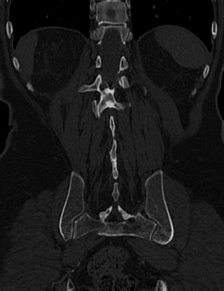 File:Anterior vertebral scalloping (abdominal aortic aneurysm) (Radiopaedia 66744-76067 Coronal bone window 58).jpg