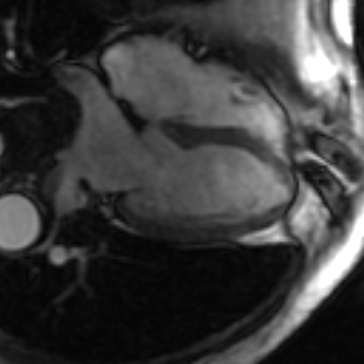 File:Anteroseptal hypokinesia after myocardial infarction (Radiopaedia 15978-15633 4 chamber view SSFE 15).jpg