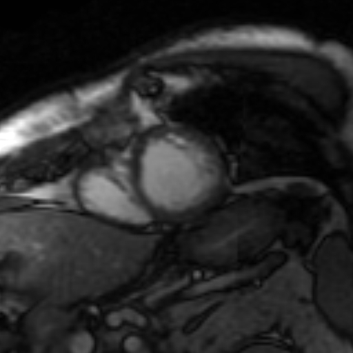 File:Anteroseptal hypokinesia after myocardial infarction (Radiopaedia 15978-15633 Short axis SSFE 29).jpg