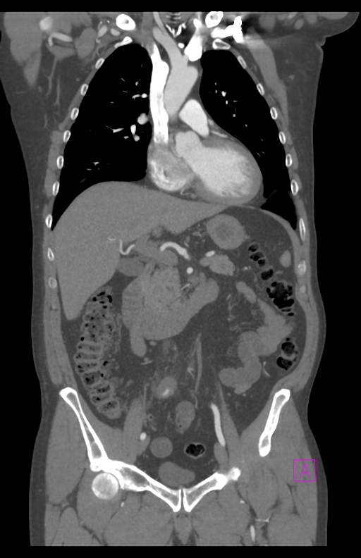 Aortectomy and axillary-bifemoral bypass (Radiopaedia 28303-28545 C 41).jpg