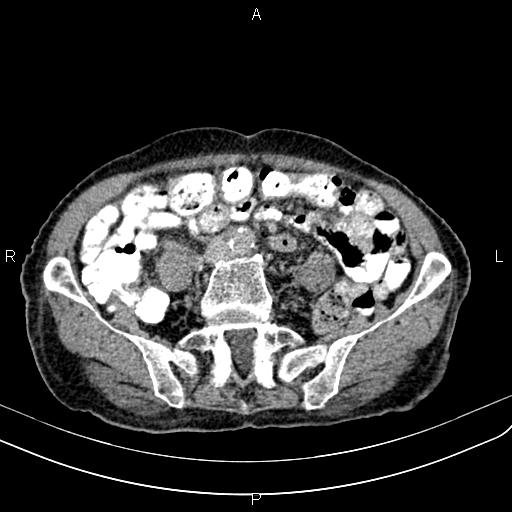 Aortic aneurysm and Lemmel syndrome (Radiopaedia 86499-102554 Axial C+ delayed 52).jpg