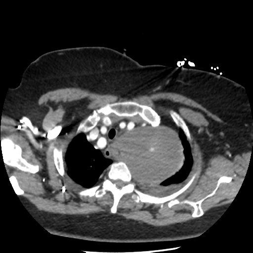 Aortic aneurysm and dissection - Stanford type A (Radiopaedia 36693-38261 A 13).png
