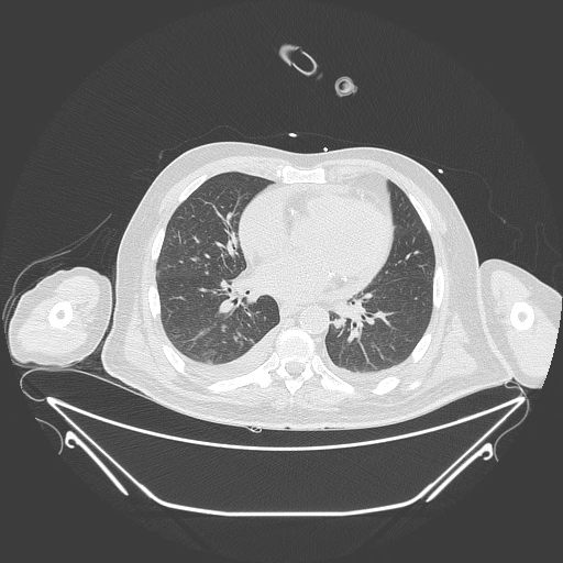 Aortic arch aneurysm (Radiopaedia 84109-99365 Axial lung window 170).jpg