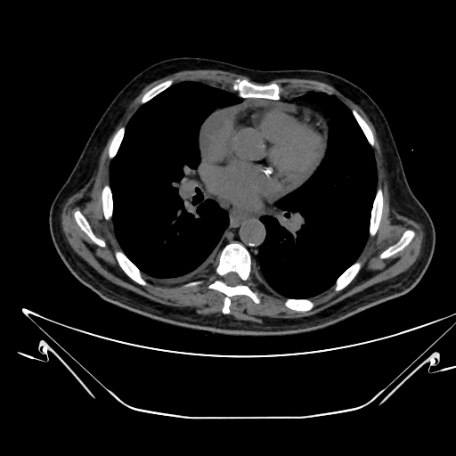 Aortic arch aneurysm (Radiopaedia 84109-99365 Axial non-contrast 152).jpg