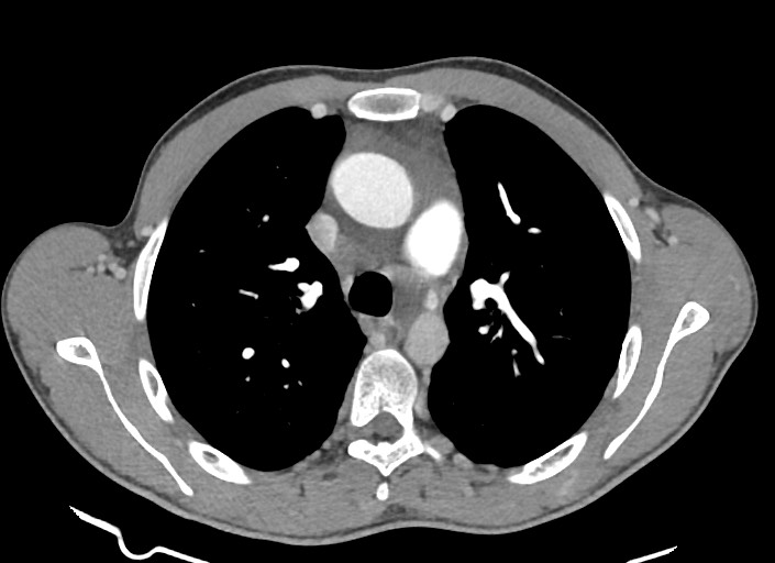 File:Aortic coarctation with aneurysm (Radiopaedia 74818-85828 A 135).jpg