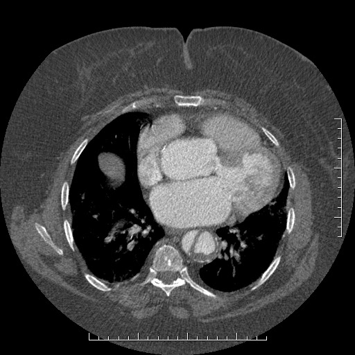 Aortic dissection- Stanford A (Radiopaedia 35729-37268 A 57).jpg
