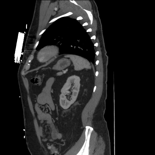 File:Aortic dissection- Stanford A (Radiopaedia 37759-39664 Sagittal C+ delayed 38).png