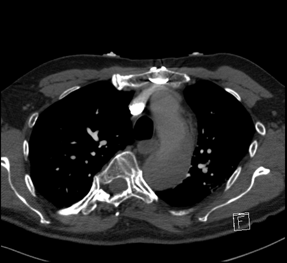 File:Aortic dissection (CTPA) (Radiopaedia 75506-86751 Axial C+ CTPA 41).jpg