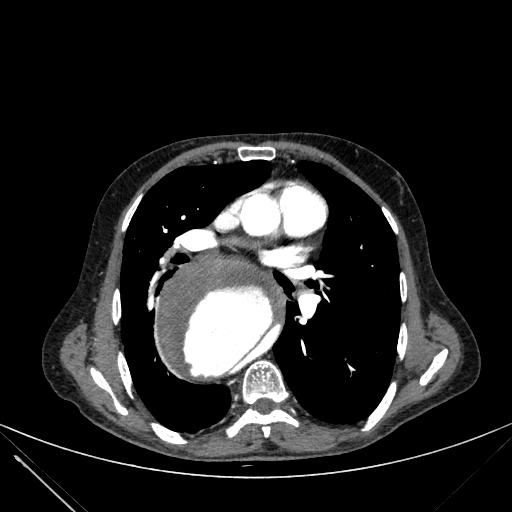 Aortic dissection (Radiopaedia 27466-27665 C+ arterial phase 128).jpg