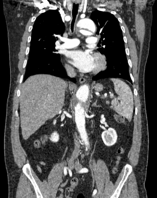 Aortic dissection (Radiopaedia 44411-48061 A 27).jpg