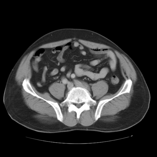 Aortic dissection (Radiopaedia 44411-48061 C 90).jpg