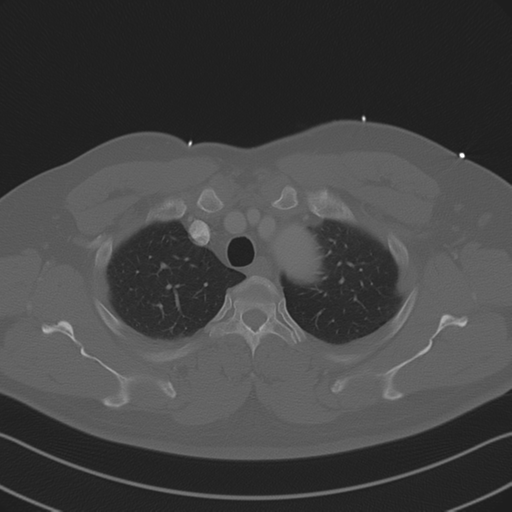 File:Aortic dissection (Radiopaedia 50763-56234 Axial bone window 25).png