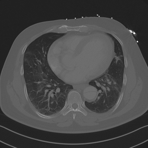 Aortic dissection (Radiopaedia 50763-56234 Axial bone window 66).png
