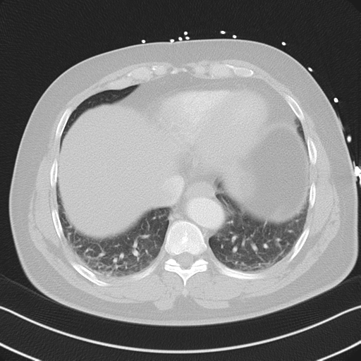 File:Aortic dissection (Radiopaedia 50763-56234 Axial lung window 50).png
