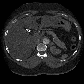 Aortic dissection (Radiopaedia 57969-64959 A 324).jpg