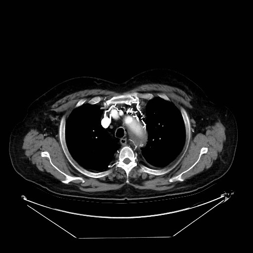 Aortic dissection (Radiopaedia 62562-71000 A 4).jpg