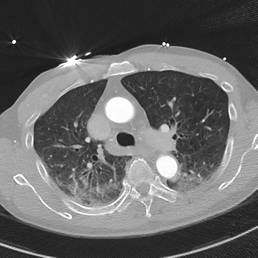 File:Aortic dissection - DeBakey type II (Radiopaedia 64302-73082 Axial lung window 22).png