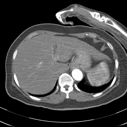 File:Aortic dissection - Stanford type A (Radiopaedia 39073-41259 A 72).png
