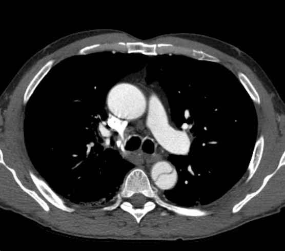 Aortic dissection - Stanford type B (Radiopaedia 73648-84437 A 37).jpg