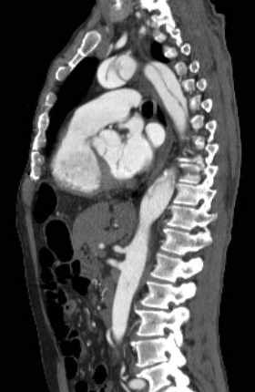 Aortic dissection - Stanford type B (Radiopaedia 73648-84437 C 68).jpg