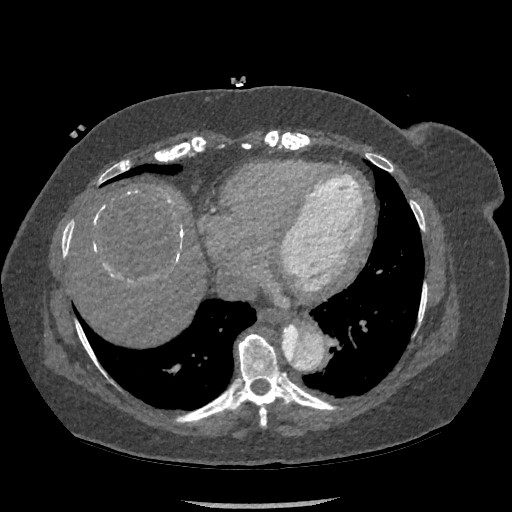 File:Aortic dissection - Stanford type B (Radiopaedia 88281-104910 A 66).jpg