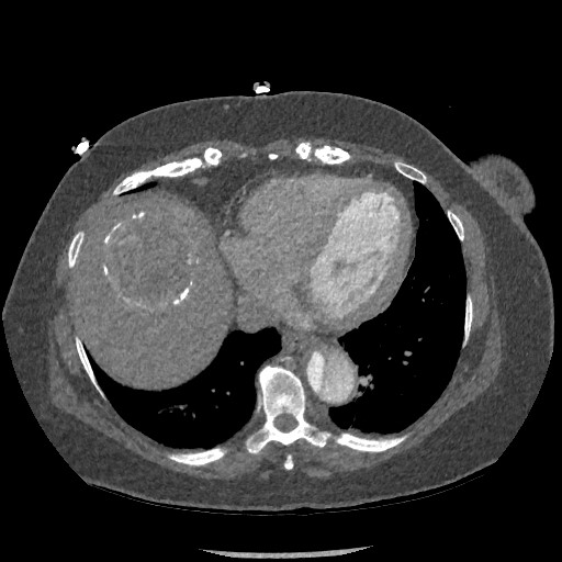 File:Aortic dissection - Stanford type B (Radiopaedia 88281-104910 A 68).jpg