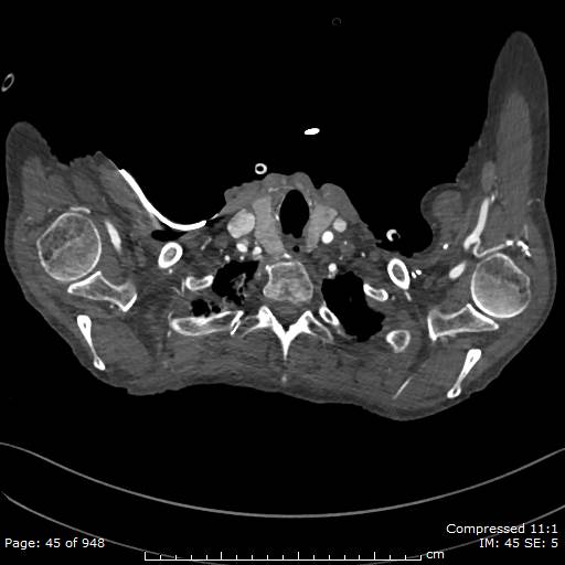 File:Aortic dissection with extension into aortic arch branches (Radiopaedia 64402-73204 B 45).jpg