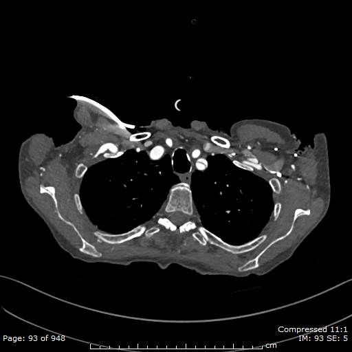 File:Aortic dissection with extension into aortic arch branches (Radiopaedia 64402-73204 B 93).jpg