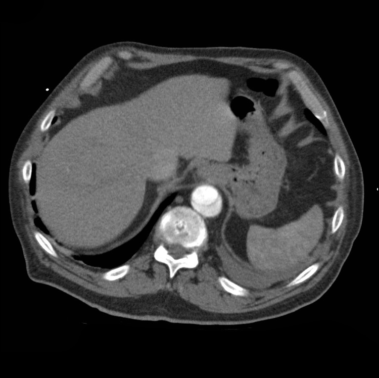 Aortic dissection with rupture into pericardium (Radiopaedia 12384-12647 A 48).jpg