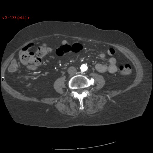 Aortic intramural hematoma (Radiopaedia 27746-28001 A 133).jpg
