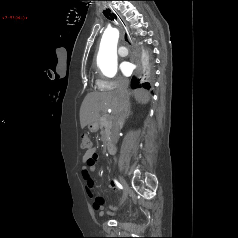 Aortic intramural hematoma (Radiopaedia 27746-28001 C 22).jpg