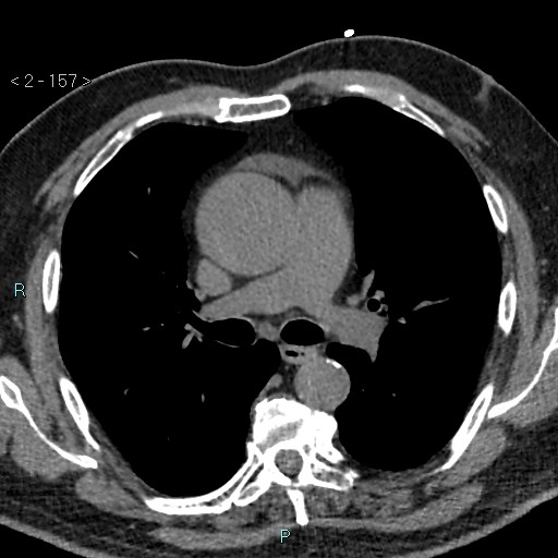 Aortic intramural hematoma (Radiopaedia 48463-53380 Axial non-contrast 69).jpg