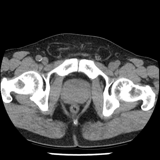 Aortic intramural hematoma (type B) (Radiopaedia 79323-92387 Axial non-contrast 114).jpg