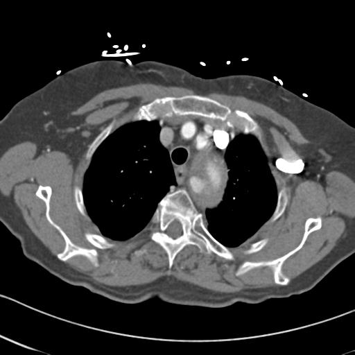 Aortic intramural hematoma from penetrating atherosclerotic ulcer (Radiopaedia 31137-31836 A 15).jpg