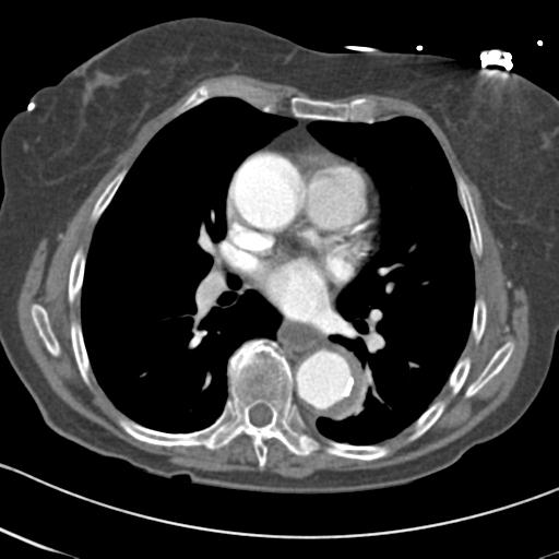 Aortic intramural hematoma from penetrating atherosclerotic ulcer (Radiopaedia 31137-31836 A 43).jpg