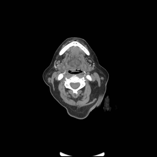File:Aortic intramural hematoma with dissection and intramural blood pool (Radiopaedia 77373-89491 B 1).jpg