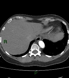 Aortic valve endocarditis (Radiopaedia 87209-103485 C 82).jpg