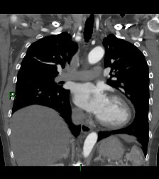 File:Aortic valve endocarditis (Radiopaedia 87209-103485 D 35).jpg