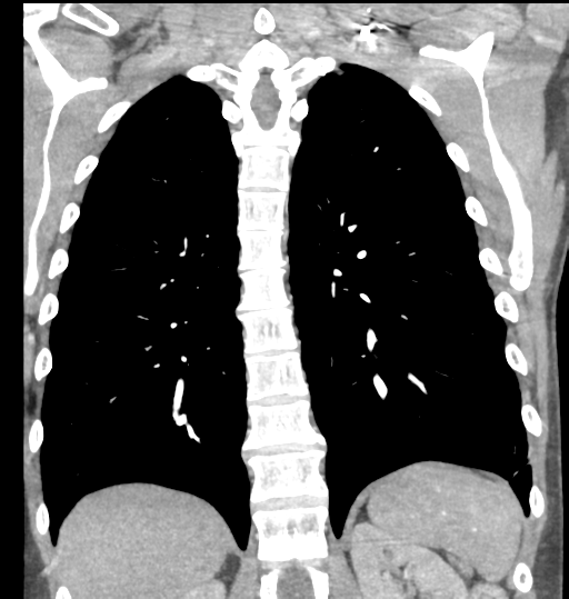 File:Aortic valve non-coronary cusp thrombus (Radiopaedia 55661-62189 C 57).png