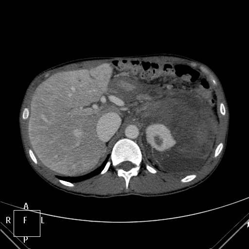 File:Aorto-left renal vein fistula (Radiopaedia 45534-49628 A 3).jpg