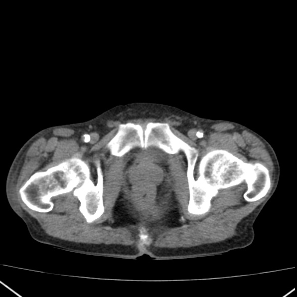 Aortoiliac occlusive disease (Radiopaedia 32134-33076 Axial non-contrast 53).jpg