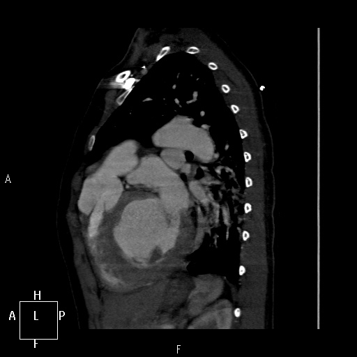 File:Aortopulmonary septal defect (Radiopaedia 41990-45013 Sagittal C+ CTPA 13).jpg