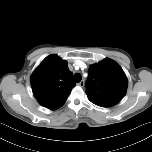 File:Apical pleural calcification (Radiopaedia 46141-50499 Axial C+ delayed 17).png
