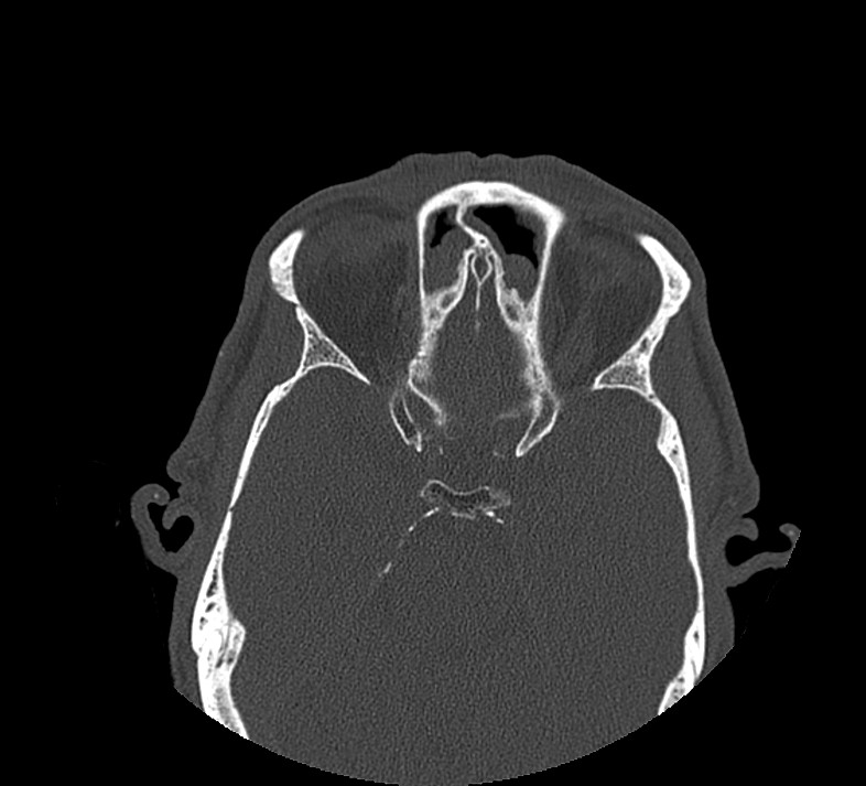Aplastic maxillary sinuses (Radiopaedia 60030-67561 Axial non-contrast 54).jpg