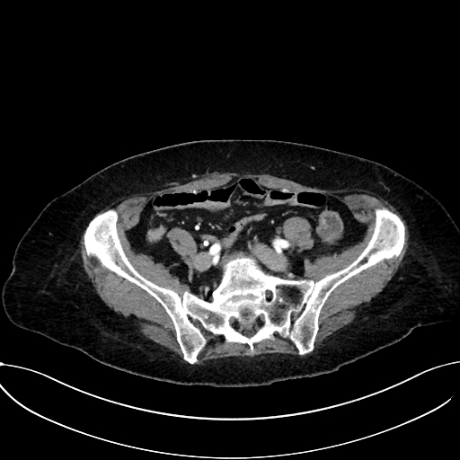 Appendiceal hemorrhage (Radiopaedia 70830-81025 A 92).jpg